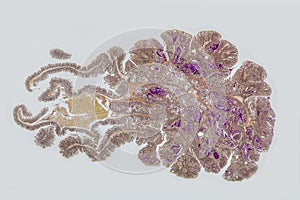 Colon polyp